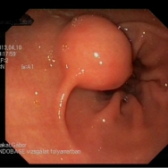Submucosus lipoma a gyomor antrumában