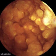 Lymphoid hyperplasia a duodenumban