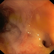 Crohn - interintestinalis fistula nyílása a colonban
