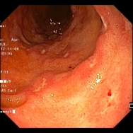 Duodenális Crohn betegség gastroscopos képe fehér fénnyel és NBI-al