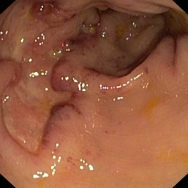 Crohn colitis
