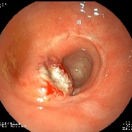  Recidív rectum tumor a varratvonalban