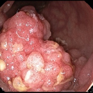  Villosus adenoma a rectumban