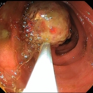Peutz-Jeghers szindrómás 15 éves leány beteg; Intraoperatív enteroszkópia során készült képek