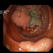 A lument obstruáló colon ascendens cc. és aboralisan a második redőn széles alapú polyp 