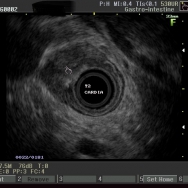 Cardia tumor (T2N1) EUS képei