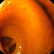 Felső panendoscopia során látható a choledochoduodenostoma nyílása, melyen betekintve a hepaticus villa is látótérbe kerül