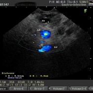 Pancreas cc. (T3N1M1 stádiumú, ascitessel) - képek, FNA