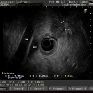 Pancreasfej tumor EUS képei, FNA a tumorból