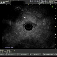 Walled-off pancreas necrosis EUS képei és szúrása