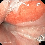 Barret metaplasia, szövettanilag LGD, fehér fénnyel és FICE képekkel 