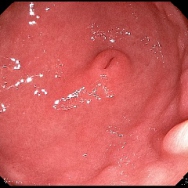 Ectopiás pancreas a gyomorban