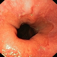 Erozív GERD - reflux oesophagitis LA-A
