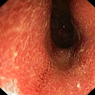Súlyos pancolitis ulcerosa