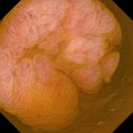 Műtét során igazolódott Meckel-diverticulum kapszula endoszkópos képe