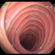 Ép jejunum enteroszkópos képe