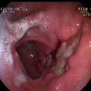 Tonogénes infiltrálást követően kialakult gyomorfal necrosis