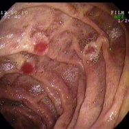 Schönlein-Henoch purpura a leszálló duodenumban, mellette kis ectopiás pancreas metaplasia
