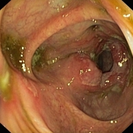 Crohn colitis a colon ascendensben - 15 éves fiú