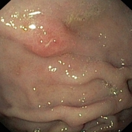 Crohn fekély a corpusban, Crohn fekélyek praepyloricusan - 15 éves fiú