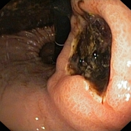 Subcardialis ulcus, tapadó coagulummal