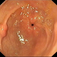 Ectopiás pancreas a gyomorban