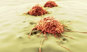A nyirokcsomó rák tünetei, szakaszai és kezelése