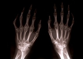 Agresszívabb lehet a reumatoid artritisz kezelése