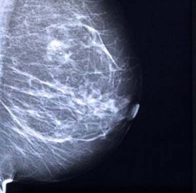 A mellrák korai diagnózisát segítő új vértesztet fejlesztenek