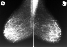 Mammogram [Forrás: Depositphotos]