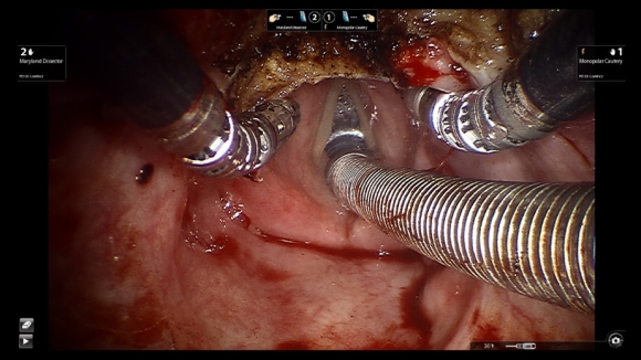 Intraoperatív kép egy daVinci-vel eltávolított kombinált nyelvgyöki (vallecula) és supraglotticus (epiglottis) tumor reszekcióját követően