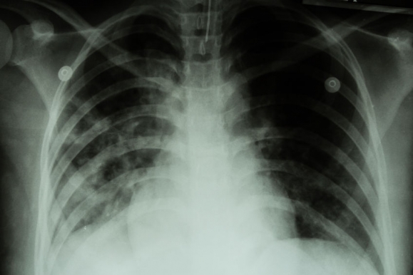 Pulmonary Tuberculosis ( TB ) : Chest x-ray show alveolar infiltration at both lung due to mycobacterium tuberculosis infection (Forrás: 123rf.com)