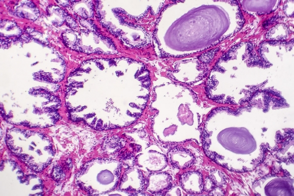 Benign prostatic hyperplasia. Micrograph shows dilated glands, papillary projections inside the lumen of the glands, cystic dilatation with accumulation of secretory material. Photo under microscope (Forrás: 123rf.com)