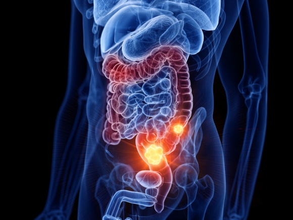 3d rendered medically accurate illustration of colon cancer (Forrás: 123rf.com)