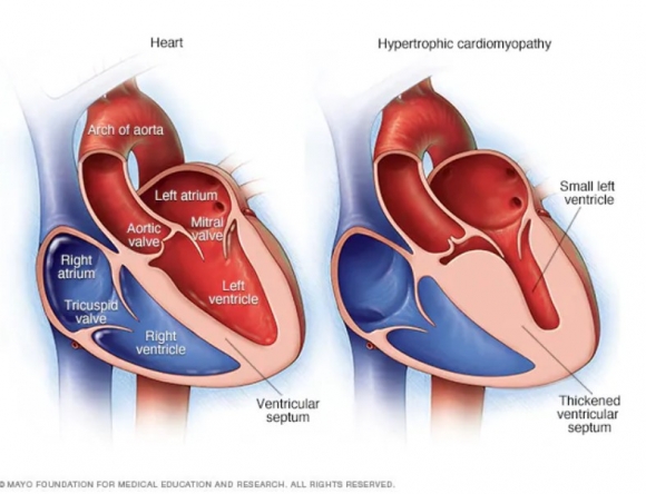 Hipertrófiás kardiomiopátiaA hipertrófiás kardiomiopátiában a szeptumnak nevezett izmos szívfal gyakran a szokásosnál vastagabbá válik. A megvastagodás azonban a bal alsó szívkamrában, más néven a bal kamrában bárhol előfordulhat. Forrás: Mayo Foundation