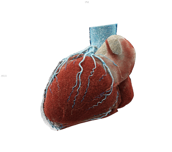 CTA Coronary  - Fotonszámláló CT-vel készült ultra nagy térbeli felbontású koszorúér-vizsgálat. A színes 3D képek részletgazdag információt nyújtanak a szív alakjáról és a kisebb méretű koszorúerek lefutásáról is.