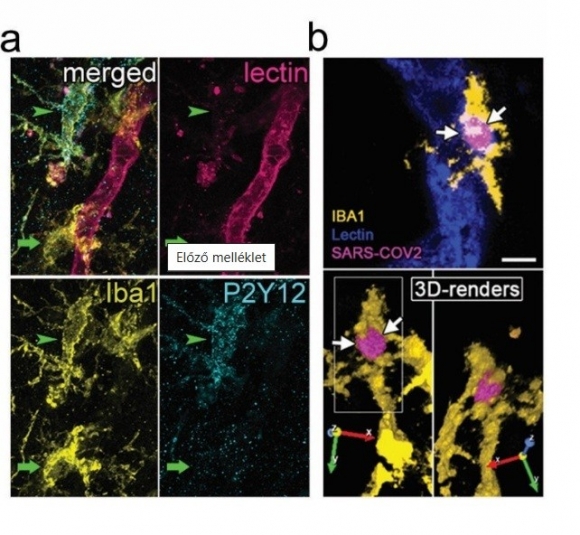a ábra: Covid-19-ben elhunyt beteg agyszövetében, az erek mellett található mikroglia sejtek elvesztik a P2Y12 receptoraikat, amelyek kulcsfontosságúak az erekkel és idegsejtekkal való kommunikáció során. b ábra: Ér melletti Iba1-pozitív mikroglia sejt 3 dimenziós modellje, amint bekebelez egy SARS-CoV-2 fertőzött immunsejtet (magenta).