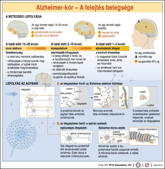 Alzheimer-kór: a felejtés betegsége; a betegség lefolyása; lefolyás az agyban, az agy érintett régiói (MTI grafika)