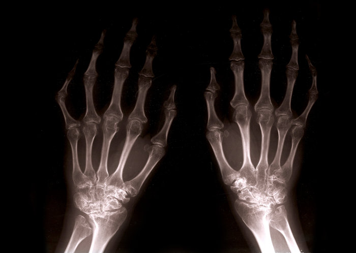 Kezdődő reumatoid arthritis tünetei. OTSZ Online - Reumás ízületi gyulladás