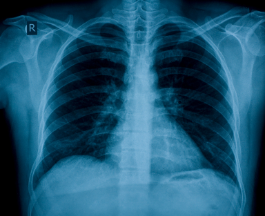 MTT - Híreink - WHO- és TNM-változások a tüdőrák patológiai diagnosztikájában - BRONKO 