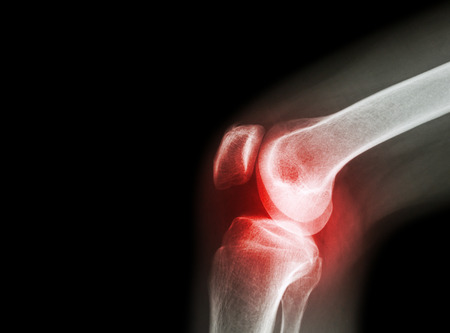 térd meniszkusz artroszkópos kezelése fájdalom a vállízületben edzés után