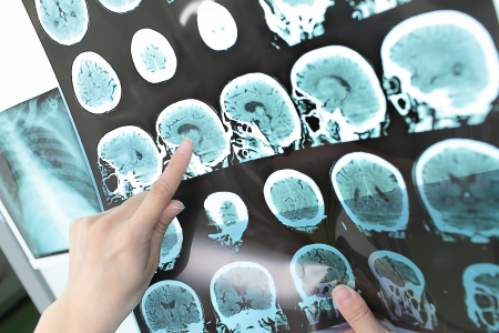 Az eljárással nagyobb biztonsággal igazolható az Alzheimer-kór, már a betegség korai szakaszában is (Fotó: MedicalOnline archiv)