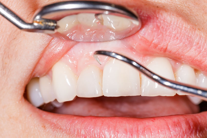 a periodontális betegség kezelésének a cukorbetegség near-es típusú cukorbetegség kezelése módszer