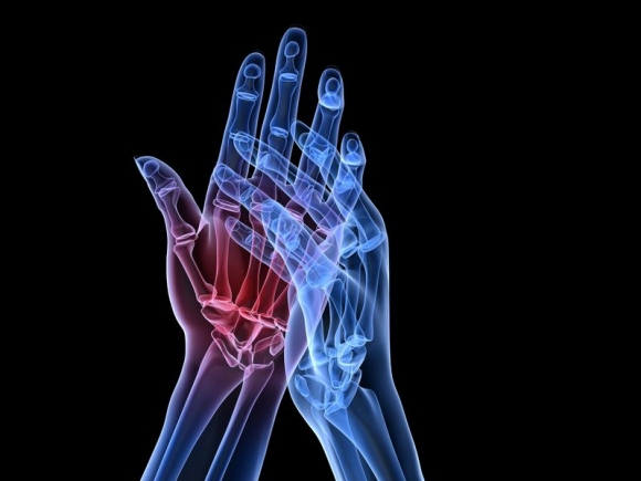 hogyan kezelhető a rheumatoid arthritis otthon